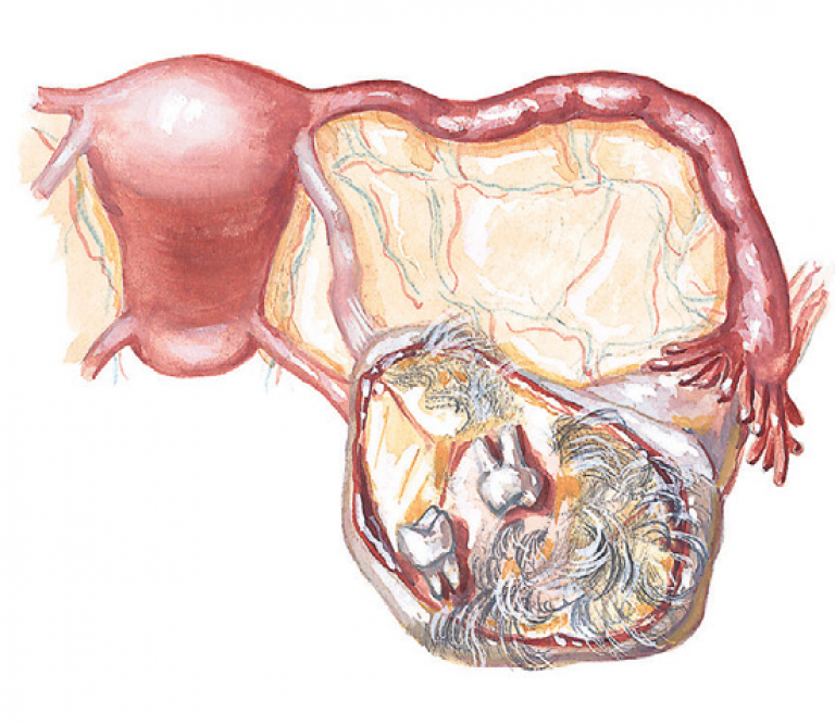 Дермоидная киста яичника. Зрелая тератома яичника. Рак яичников причины