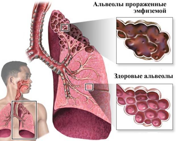 Рак легких - симптомы и признаки | центр лечения онкологии см-клиники