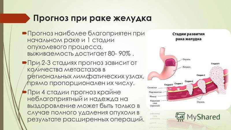 Онкология желудка 4 стадия. Степени онкологии желудка. Опухоль желудка стадии. Онкология 1 степени желудка. Желудок этапы метастазирования.