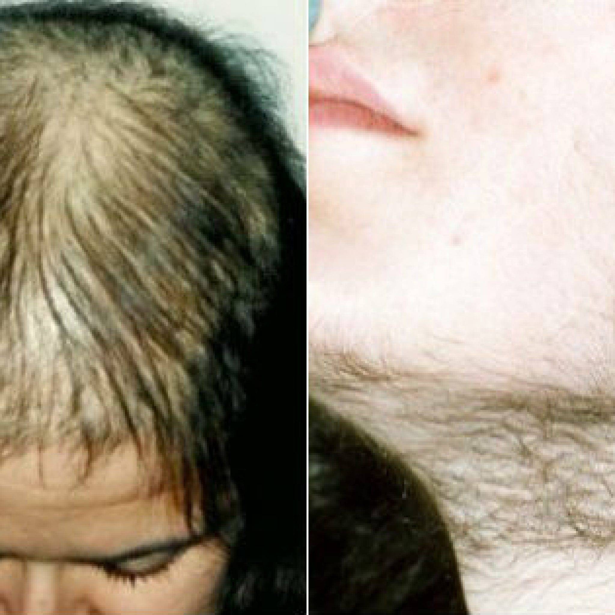 Могут ли выпадать волосы у женщин из за тестостерона