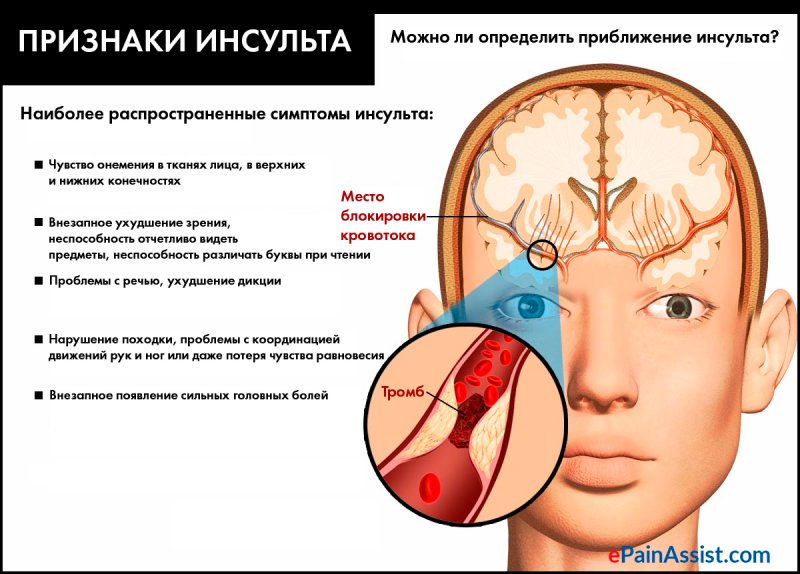 Признак жизни головного мозга. Инсульт микроинсульт. Проявление микроинсульта симптомы. Микроинсульт причины и симптомы. Микроинсульт осложнения.
