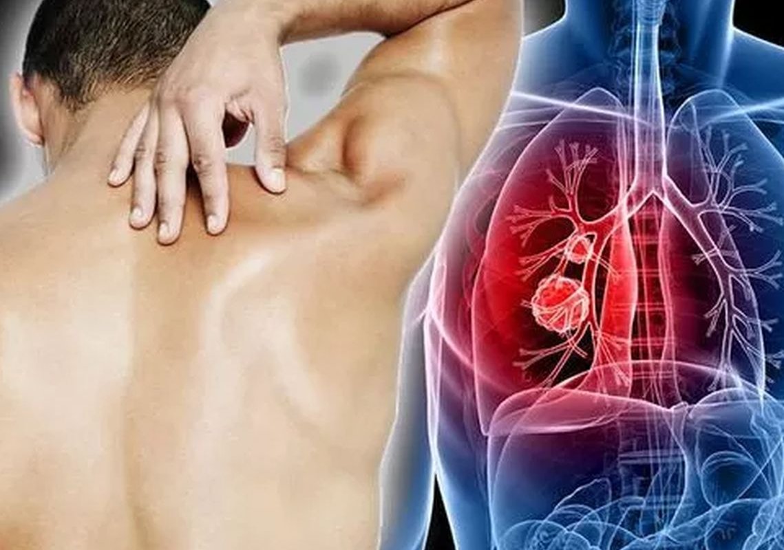 Рак легких: признаки и симптомы онкологии легких на первых стадиях у мужчин и женщин | клиники «евроонко»