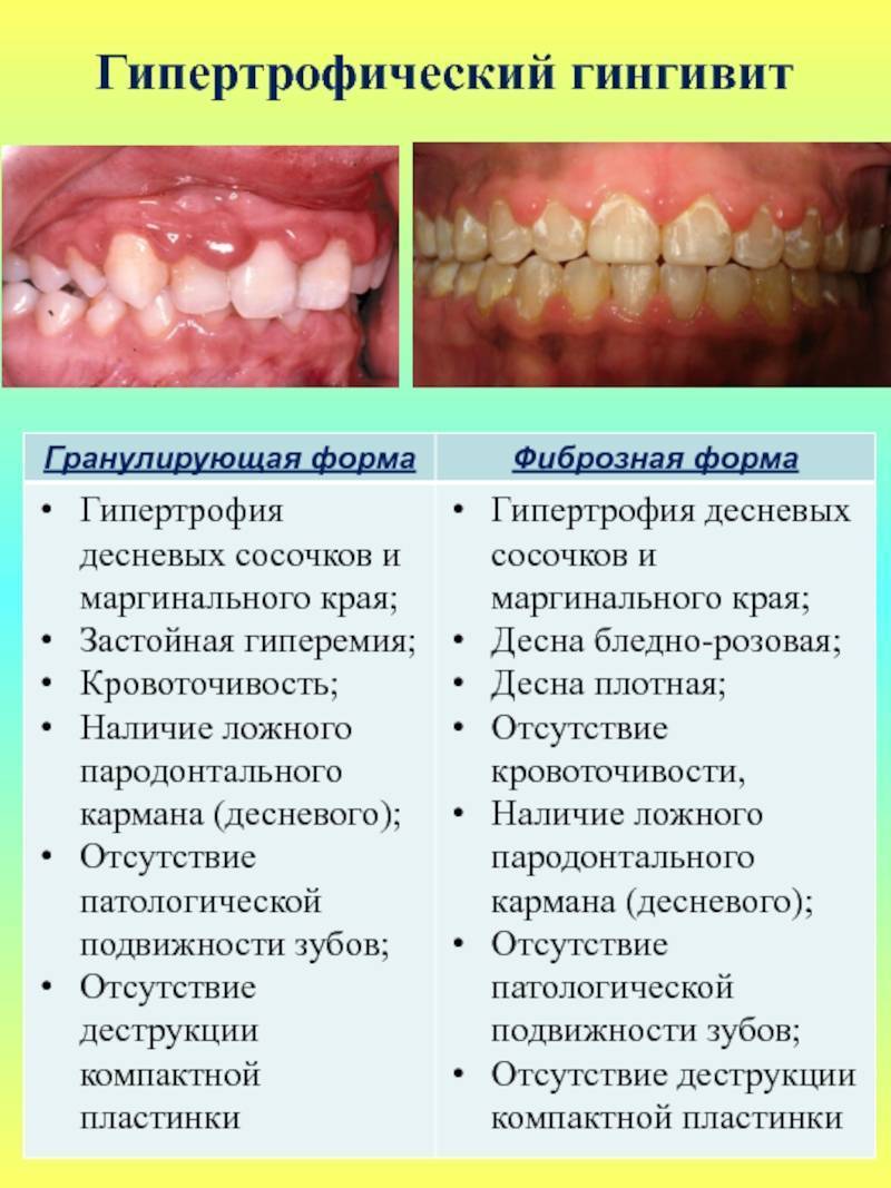 Признаки лечения зубов. Гипертрофический гингивит отечная форма. Некротический гингивит Венсана. Гипертрофический гингивит фиброзная форма. Язвенно некротический гингивит.